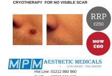 “MOLE” ,SKIN TAG TREATMENT WITH CRYOTHERAPY WAS £250 NOW£60